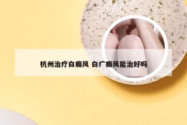 杭州治疗白癜风 白疒癜风能治好吗