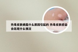 热毒皮肤病是什么原因引起的 热毒皮肤感染会出现什么情况