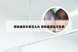 静脉曲张长癣怎么办 静脉曲张起红色癣