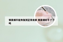 银屑病不能恢复到正常皮肤 银屑病好不了了吗