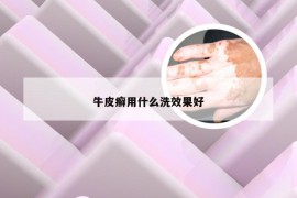 牛皮癣用什么洗效果好