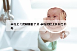 手指上长皮癣用什么药 手指皮肤上长癣怎么办