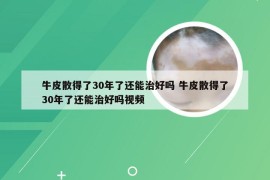 牛皮散得了30年了还能治好吗 牛皮散得了30年了还能治好吗视频