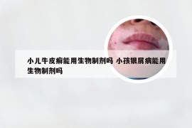 小儿牛皮癣能用生物制剂吗 小孩银屑病能用生物制剂吗