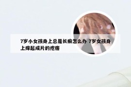 7岁小女孩身上总是长癣怎么办 7岁女孩身上痒起成片的疙瘩