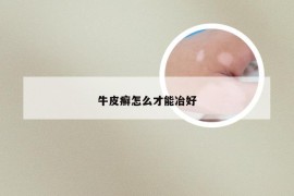 牛皮癣怎么才能冶好