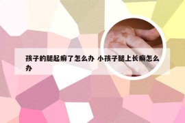 孩子的腿起癣了怎么办 小孩子腿上长癣怎么办