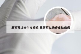 黑茶可以治牛皮癣吗 黑茶可以治疗皮肤病吗