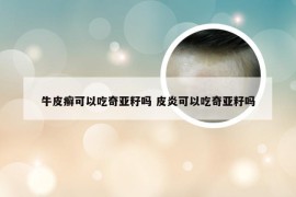 牛皮癣可以吃奇亚籽吗 皮炎可以吃奇亚籽吗