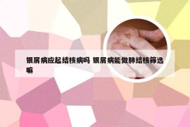 银屑病应起结核病吗 银屑病能做肺结核筛选嘛