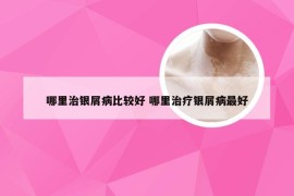 哪里治银屑病比较好 哪里治疗银屑病最好