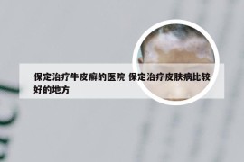 保定治疗牛皮癣的医院 保定治疗皮肤病比较好的地方