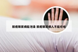 脓疱银屑病能泡澡 脓疱银屑病人不能吃啥