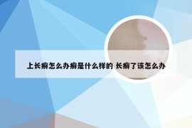 上长癣怎么办癣是什么样的 长癣了该怎么办