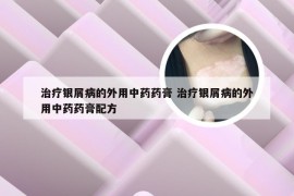 治疗银屑病的外用中药药膏 治疗银屑病的外用中药药膏配方