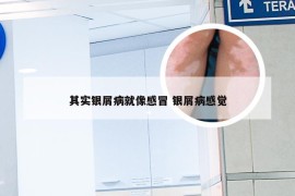 其实银屑病就像感冒 银屑病感觉