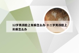 12岁男孩脸上有癣怎么办 十二岁男孩脸上长癣怎么办