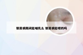 银屑病期间能哺乳么 银屑病能喂奶吗