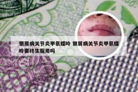 银屑病关节炎甲氨蝶呤 银屑病关节炎甲氨蝶呤要终生服用吗