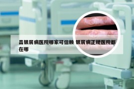 昌银屑病医院哪家可信赖 银屑病正规医院都在哪