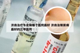 济南治疗牛皮癣那个医院最好 济南治银屑病最好的三甲医院