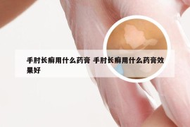 手肘长癣用什么药膏 手肘长癣用什么药膏效果好