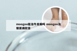 moogoo能治牛皮癣吗 moogoo治银屑病软膏