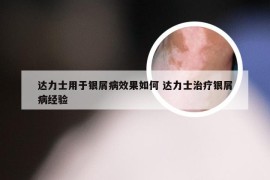 达力士用于银屑病效果如何 达力士治疗银屑病经验