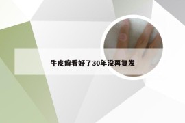 牛皮癣看好了30年没再复发