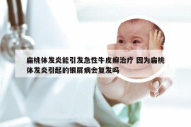 扁桃体发炎能引发急性牛皮癣治疗 因为扁桃体发炎引起的银屑病会复发吗