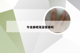 牛皮癣吧耳朵管用吗