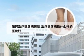 如何治疗银屑病医院 治疗银屑病找什么样的医院好