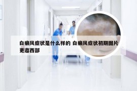 白癞风症状是什么样的 白癞风症状初期图片更邀西部