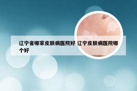 辽宁省哪家皮肤病医院好 辽宁皮肤病医院哪个好