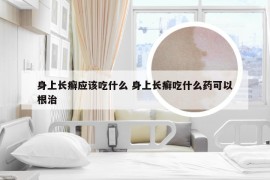 身上长癣应该吃什么 身上长癣吃什么药可以根治