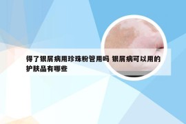 得了银屑病用珍珠粉管用吗 银屑病可以用的护肤品有哪些