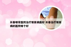 长春哪家医院治疗银屑病最好 长春治疗银屑病的医院哪个好