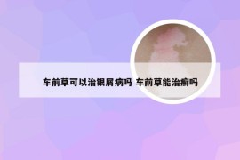 车前草可以治银屑病吗 车前草能治癣吗