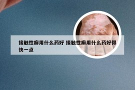 接触性癣用什么药好 接触性癣用什么药好得快一点