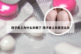 孩子身上为什么长癣了 孩子身上长藓怎么办