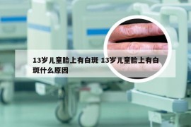 13岁儿童脸上有白斑 13岁儿童脸上有白斑什么原因