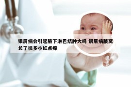 银屑病会引起腋下淋巴结肿大吗 银屑病腋窝长了很多小红点痒