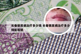 长春银屑病治疗多少钱 长春银屑病治疗多少钱能报销