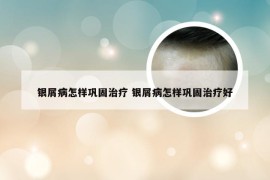 银屑病怎样巩固治疗 银屑病怎样巩固治疗好