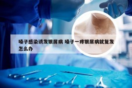 嗓子感染诱发银屑病 嗓子一疼银屑病就复发怎么办