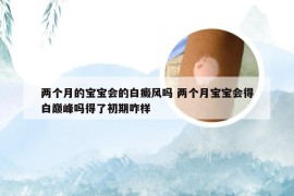 两个月的宝宝会的白癜风吗 两个月宝宝会得白巅峰吗得了初期咋样