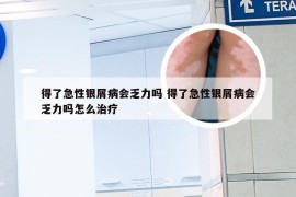 得了急性银屑病会乏力吗 得了急性银屑病会乏力吗怎么治疗