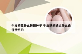 牛皮癣靠什么转播种子 牛皮肤癣通过什么途径传热的