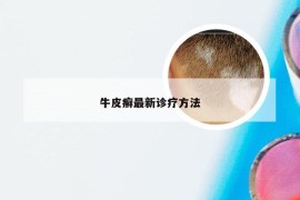 牛皮癣最新诊疗方法