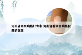 河南省银屑病最好专家 河南省看银屑病最权威的医生